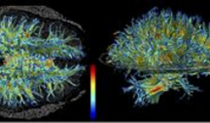 Image of 2 brain sections, control vs. diseased.